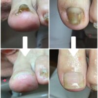 【巻き爪】ビフォーアフター写真