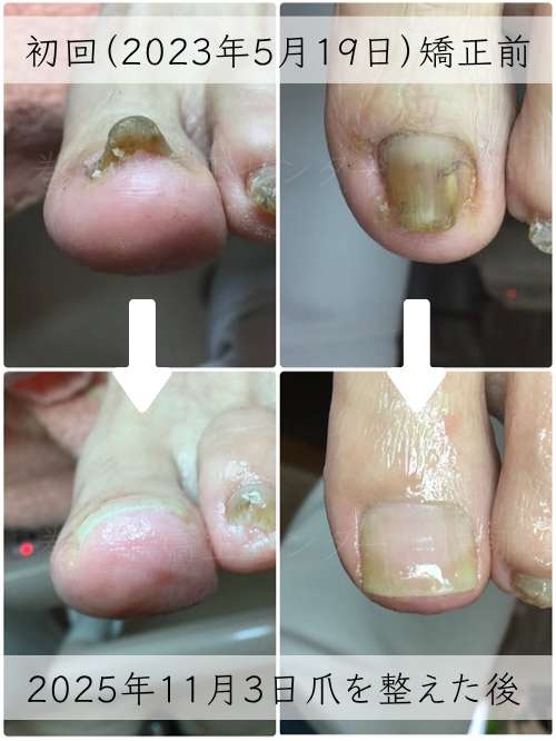 【巻き爪】ビフォーアフター写真