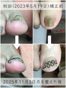 【巻き爪】ビフォーアフター写真