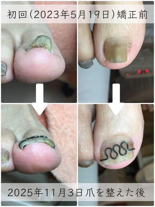 【巻き爪】ビフォーアフター写真