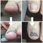 【巻き爪】ビフォーアフター写真