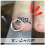 【巻き爪】食い込みの跡