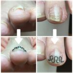 【巻き爪】ビフォーアフター写真