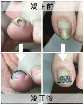 【巻き爪】ビフォーアフター写真