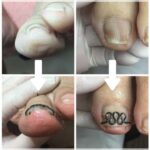 【巻き爪】ビフォーアフター写真