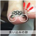 【巻き爪】食い込みの跡