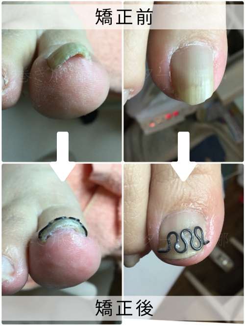 【巻き爪】ビフォーアフター写真