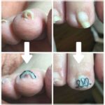 【巻き爪】ビフォーアフター写真