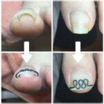 【巻き爪】ビフォーアフター写真