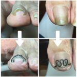 【巻き爪】ビフォーアフター写真
