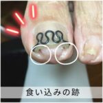 【巻き爪】食い込みの跡