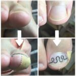 【巻き爪】ビフォーアフター写真