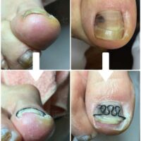 【巻き爪】ビフォーアフター写真