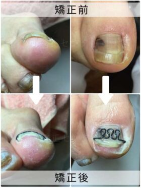 【巻き爪】ビフォーアフター写真
