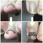 【巻き爪】ビフォーアフター写真