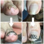 【巻き爪】ビフォーアフター写真
