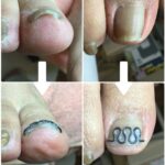 【巻き爪】ビフォーアフター写真