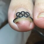 【巻き爪】食い込みの跡