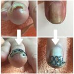 【巻き爪】ビフォーアフター写真