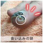 【巻き爪】食い込みの跡
