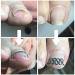 【巻き爪】ビフォーアフター写真