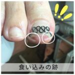 【巻き爪】食い込みの跡