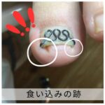 【巻き爪】食い込みの跡