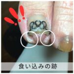 【巻き爪】食い込みの跡