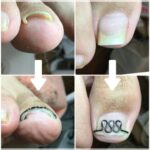 【巻き爪】ビフォーアフター写真