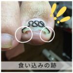 【巻き爪】食い込みの跡