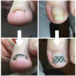 【巻き爪】ビフォーアフター写真