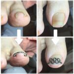 【巻き爪】ビフォーアフター写真