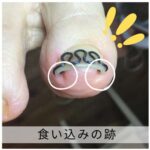 【巻き爪】食い込みの跡