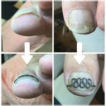 【巻き爪】ビフォーアフター写真