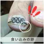 【巻き爪】食い込みの跡