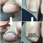 【巻き爪】ビフォーアフター写真