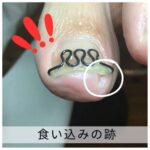 【巻き爪】食い込みの跡