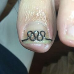 矯正後