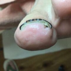 矯正後