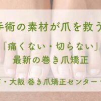 心臓手術の素材が爪を救う！？「痛くない・切らない」最新の巻き爪矯正