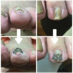 【巻き爪】ビフォーアフター写真