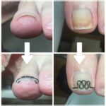 【巻き爪】ビフォーアフター写真