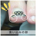 【巻き爪】食い込みの跡