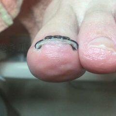 矯正後