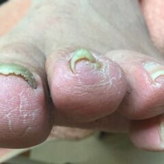 矯正前