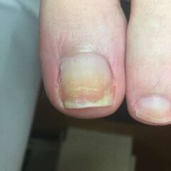 矯正前