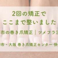 長年の巻き爪が2回の矯正で終了