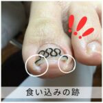 【巻き爪】食い込みの跡