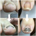 【巻き爪】ビフォーアフター写真