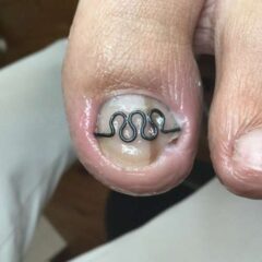 矯正後